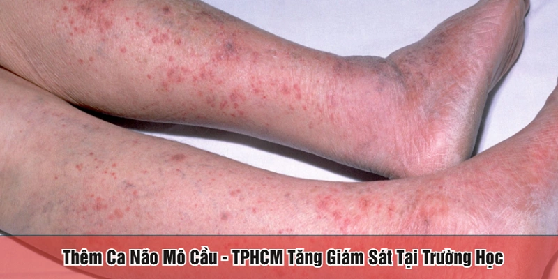 thêm ca não mô cầu